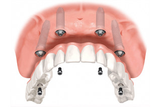 Fixed Dentures