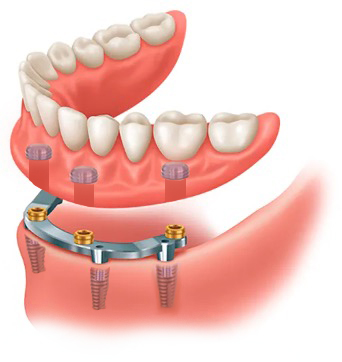 Removable Dentures